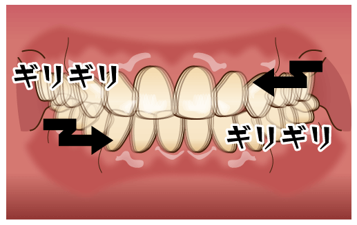 歯ぎしりと噛みしめ（ブラキシズム）について