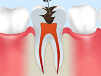 歯髄の除去