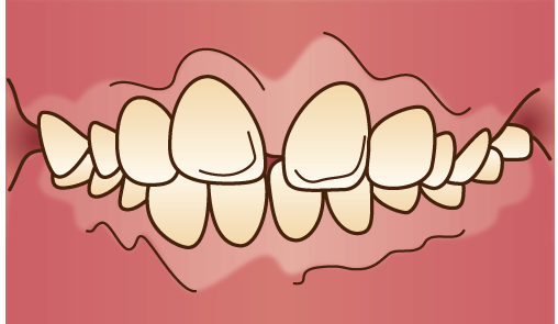 上顎前突（じょうがくぜんとつ）