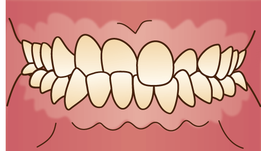 交叉咬合（こうさこうごう）